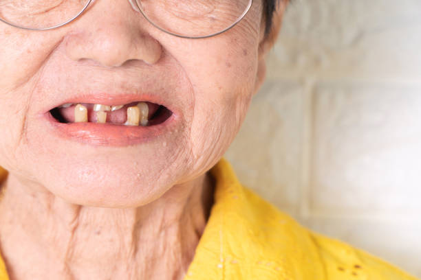 高齢の歯の様子