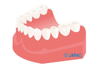 インプラント治療後の歯茎のイメージ画像